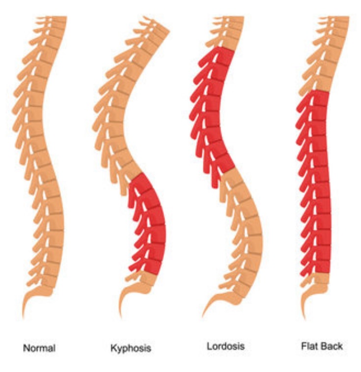 lordose cyphose